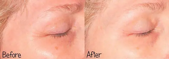 Baby-Quasar-MD-PLUS-before-after