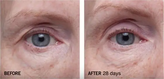 Dr-Dennis-Gross-Ferulic-Retinol-Triple-Correction-Eye-Serum-before-after