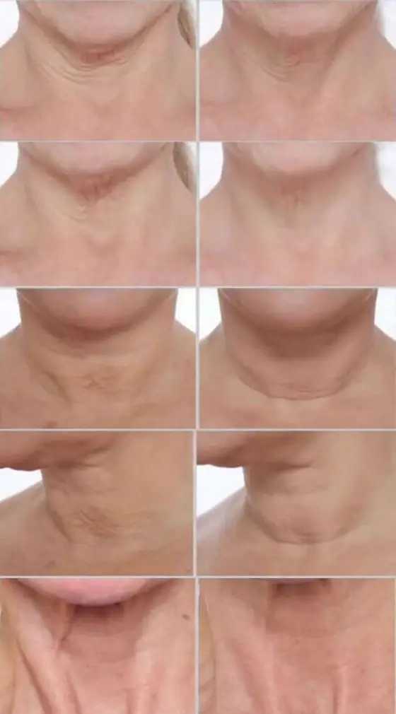 PRAI-AGELESS-Throat-Ionic-Device-before-after-photos