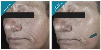 SkinCeuticals-C-E-Ferulic-before-afer-photos