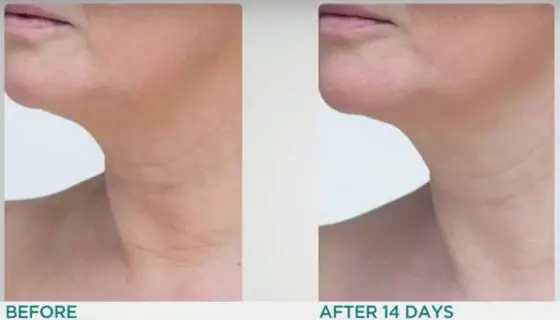StriVectin-TL-Advanced-Tightening-Neck-Cream-before-after-photos