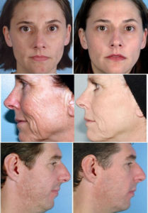 microdermabrasion