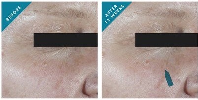 SkinCeuticals-C-E-Ferulic-results