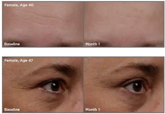 SkinMedica-TNS-Essential-Serum-before-after-photos