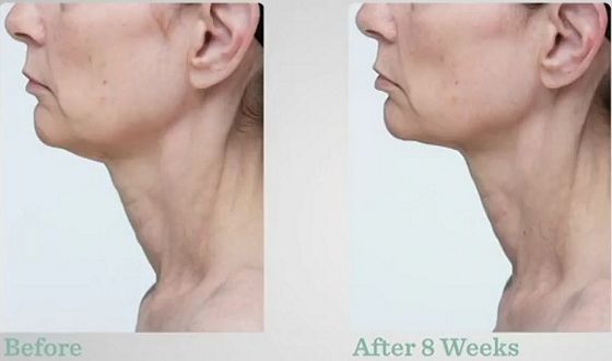 StriVectin-TL-Advanced-Tightening-Neck-Cream-results