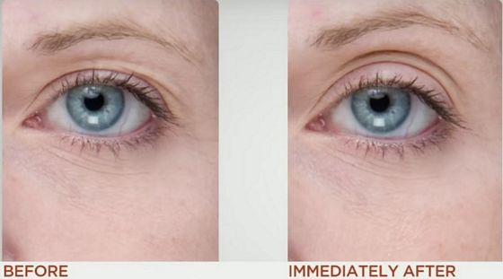 nuface-before-after