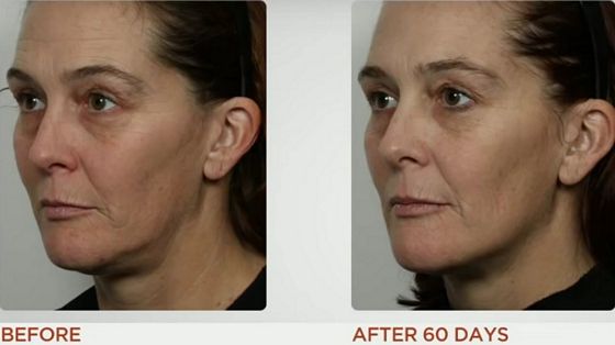 nuface-mini-before-after