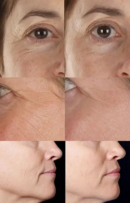 silkn-facefx-before-after-photos