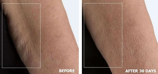 NuBODY before after results