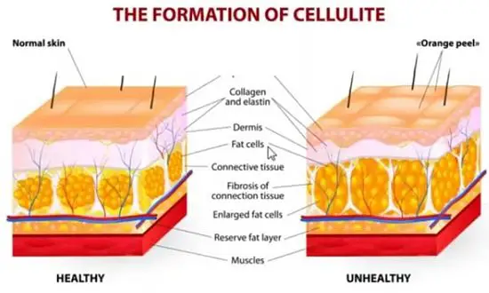 celllulite formation