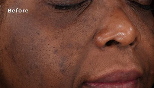 how to clear dark spots