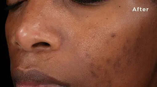 reduce black spots on face