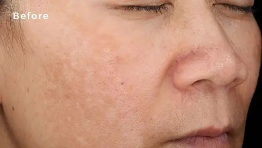 treatment for black marks on face