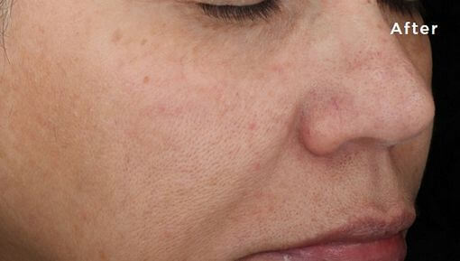 treatment for black patches on face