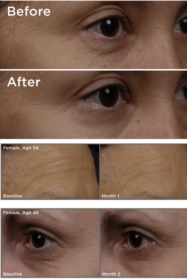 TNS-serum-before-after