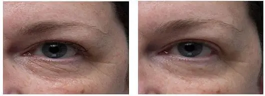 red led light therapy before and after pictures