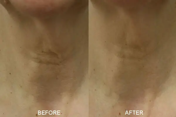 neck-cream-before-after