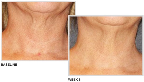 neck cream results