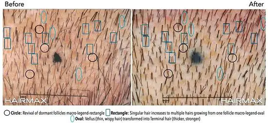 clinical-results-hairmax