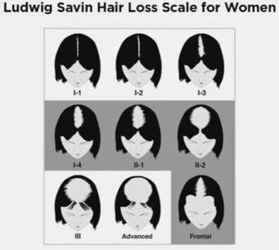 ludwig-savin-hair-loss-scale-for-women