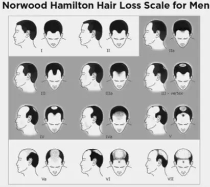 norwood-hamilton-hair-loss-scale-for-men