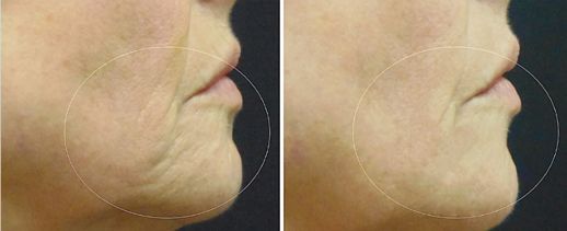 how to tighten skin on face without surgery