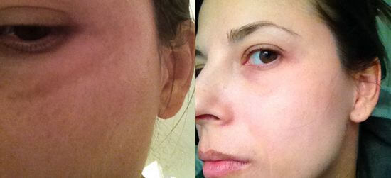 skin whitening treatment before and after