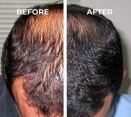 laser hair cap before and after