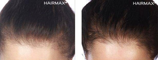 hairmax-results