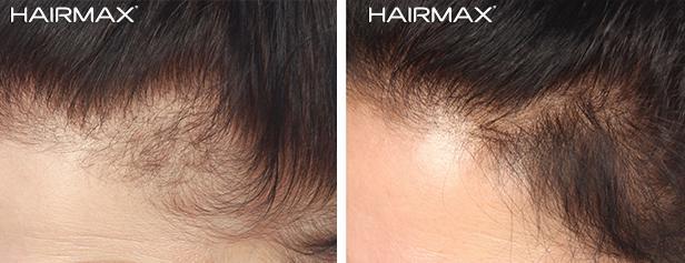 hairmax_before_after