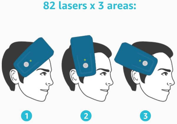 laserband-treatment-areas