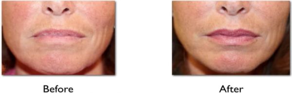 drooping mouth corners before and after