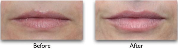 fillers for droopy mouth corners