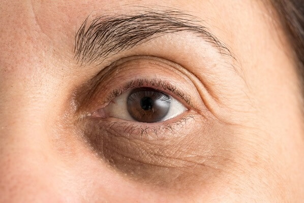 How to Fix Hyperpigmentation Under Eyes