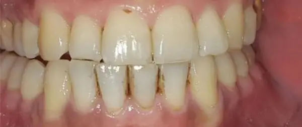 ToothWave results