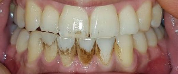 ToothWave results