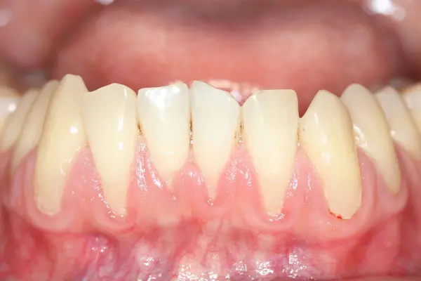Receding Gums