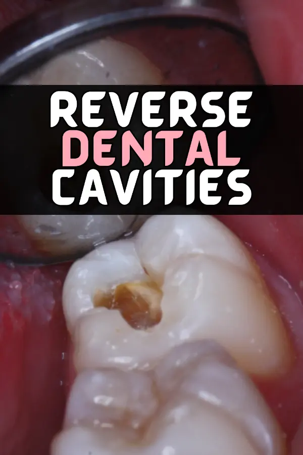 Reverse Dental Cavities
