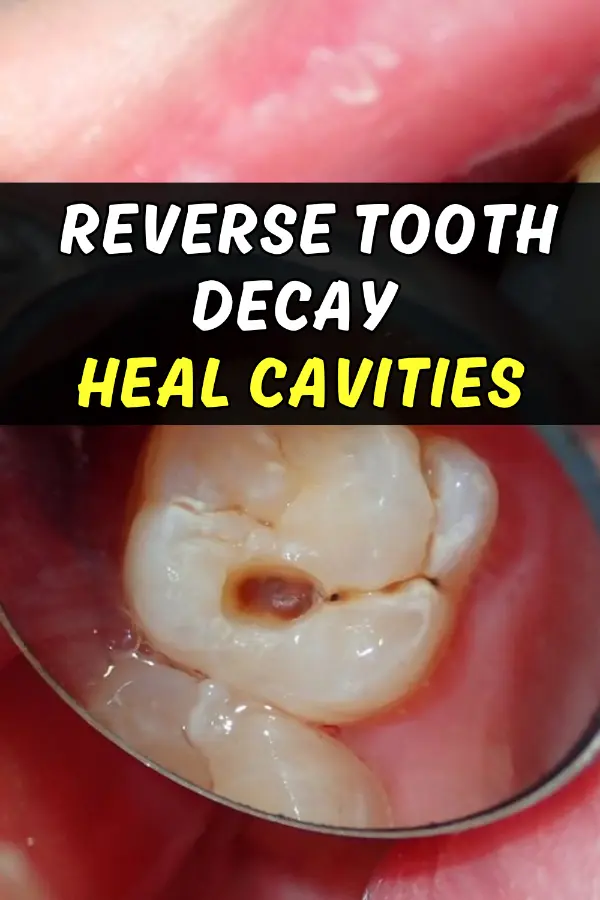 Reverse Tooth Decay Heal Cavities