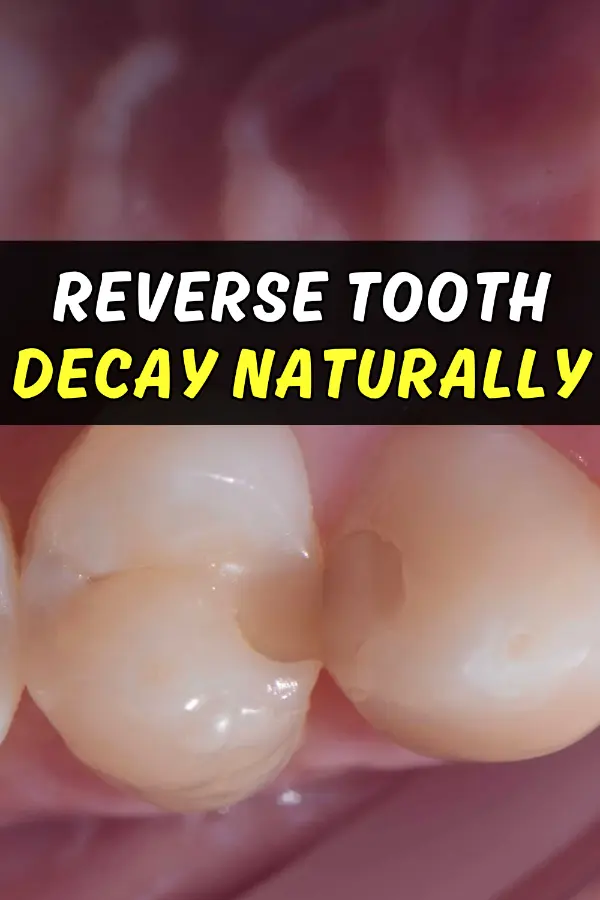 Reverse Tooth Decay Naturally