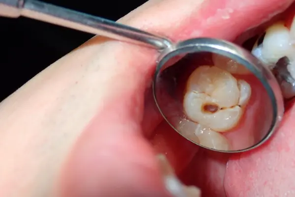 Reverse Tooth Decay