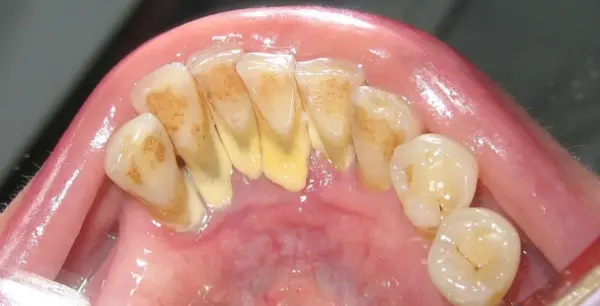 #1 Remedy for Dental Plaque Removal at Home